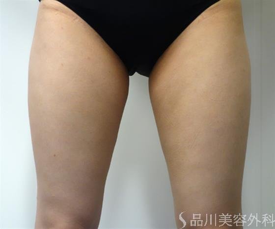 症例NO.43569のAFTER写真