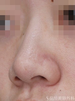 症例NO.70909のBEFORE写真