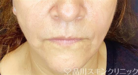 症例NO.61354のAFTER写真