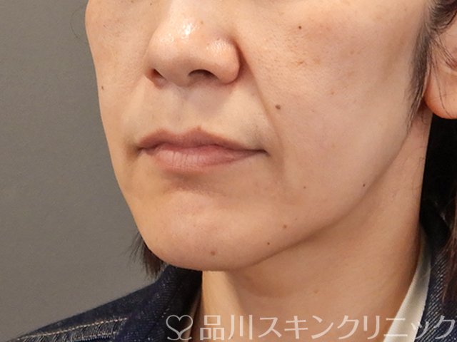 症例NO.75087のBEFORE写真