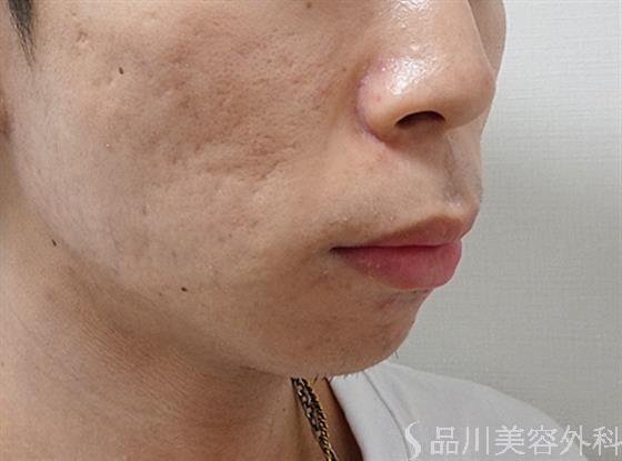 症例NO.53032のBEFORE写真