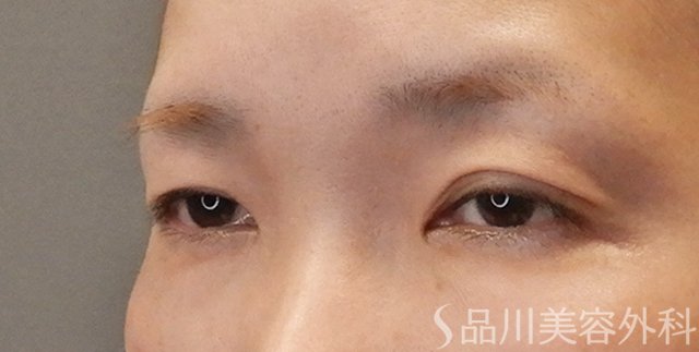 症例NO.75109のBEFORE写真