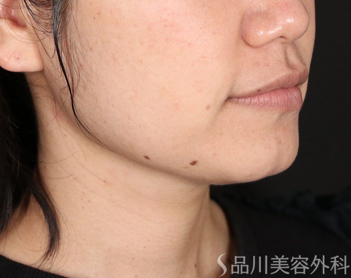 症例NO.73830のBEFORE写真