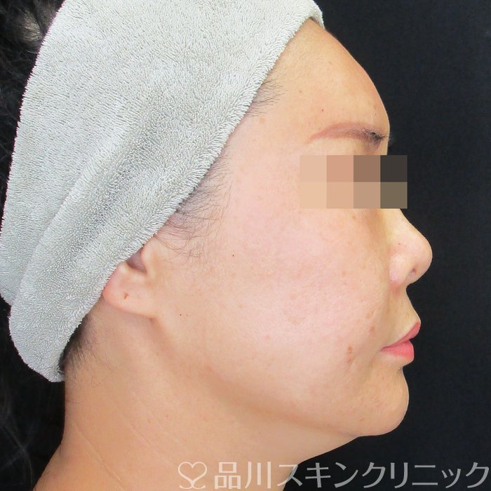 症例NO.74326のAFTER写真