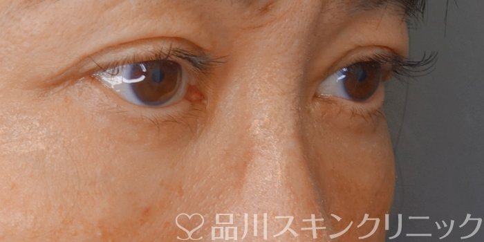 症例NO.71475のAFTER写真
