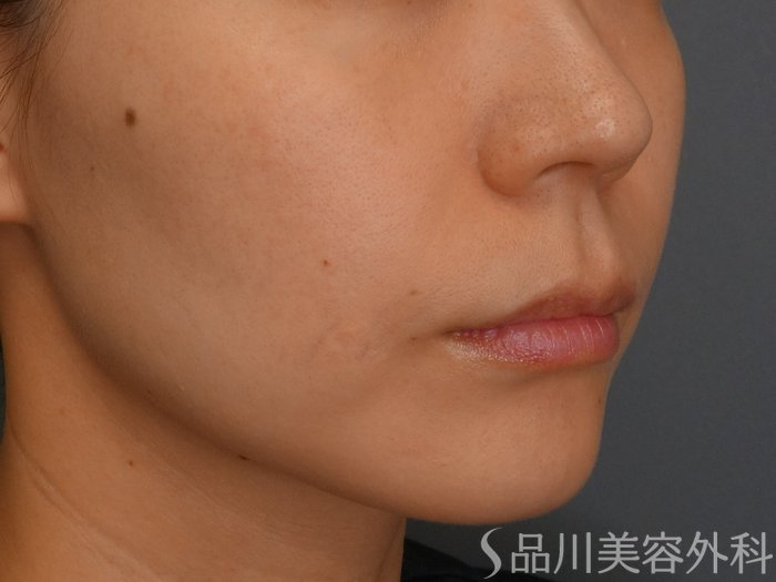 症例NO.73694のBEFORE写真