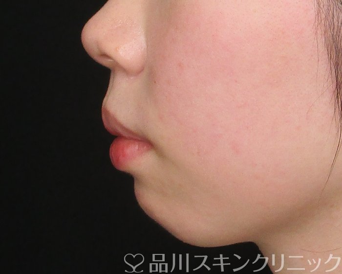 症例NO.69740のBEFORE写真