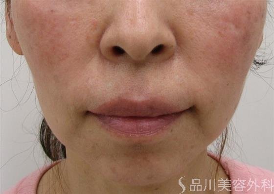 症例NO.43619のBEFORE写真