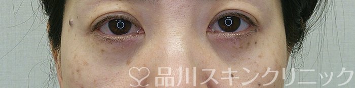 症例NO.70722のAFTER写真