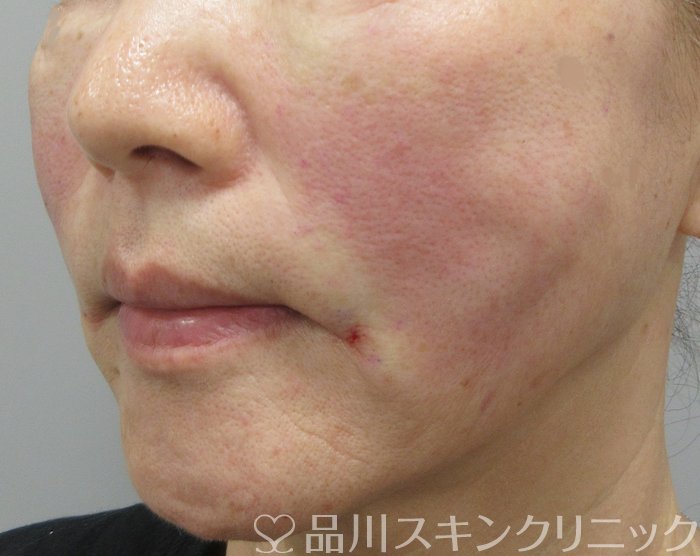 症例NO.72090のAFTER写真