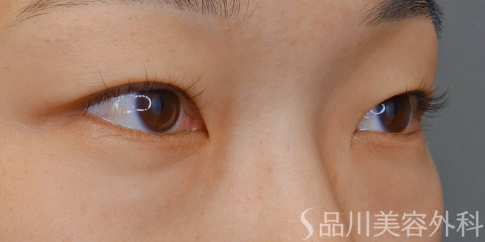 症例NO.71685のBEFORE写真