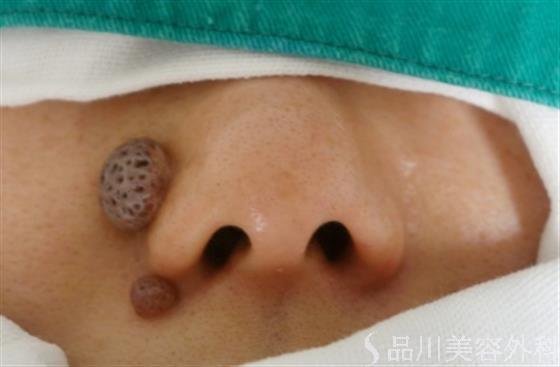 症例NO.27695のBEFORE写真
