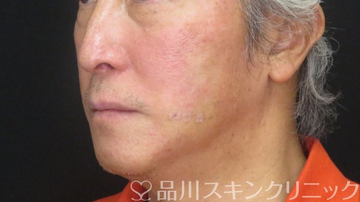 症例NO.73480のAFTER写真