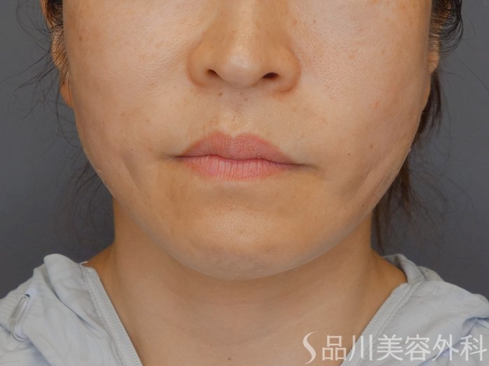 症例NO.71087のAFTER写真