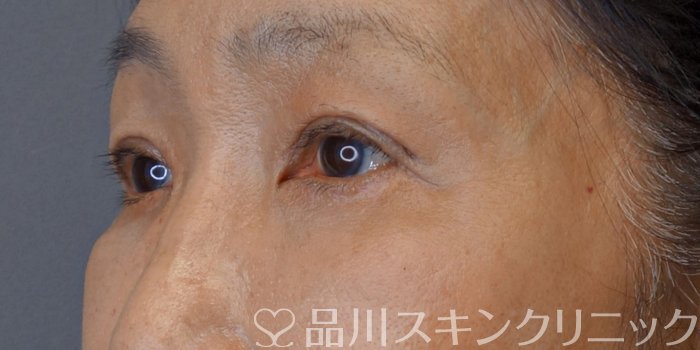 症例NO.74677のAFTER写真