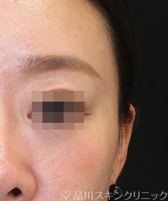 症例NO.73557のBEFORE写真