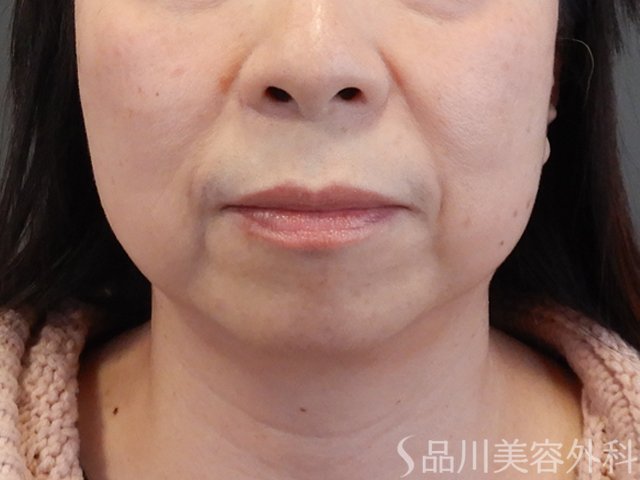 症例NO.69230のBEFORE写真