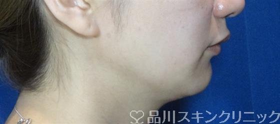 症例NO.32771のAFTER写真