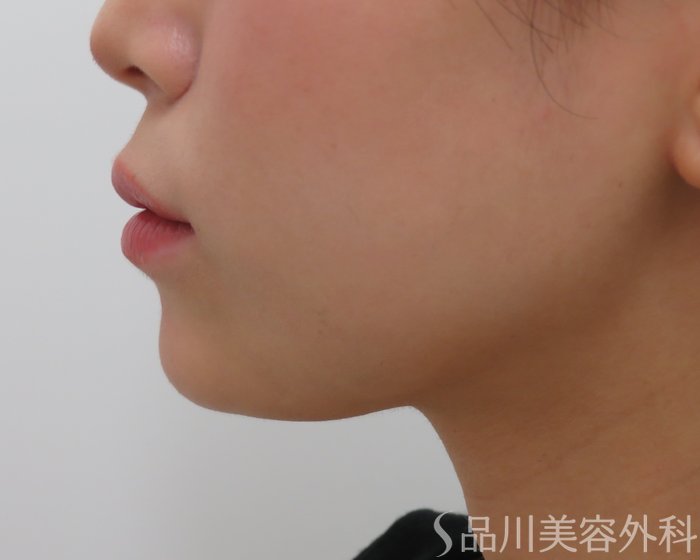症例NO.65630のAFTER写真
