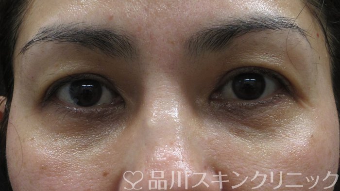 症例NO.70505のAFTER写真