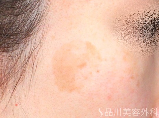 症例NO.64270のBEFORE写真