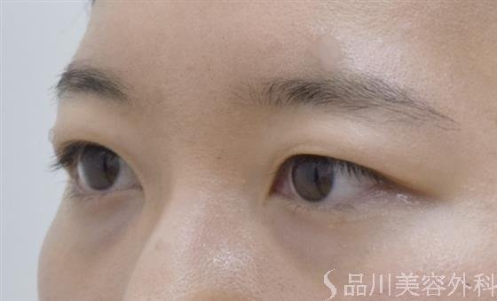 症例NO.54042のBEFORE写真