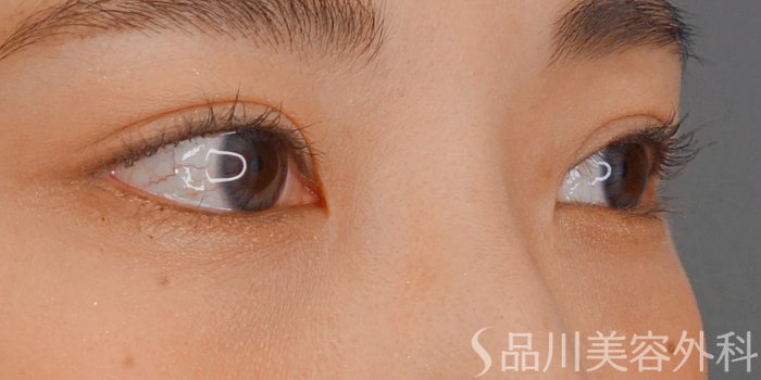 症例NO.72352のAFTER写真