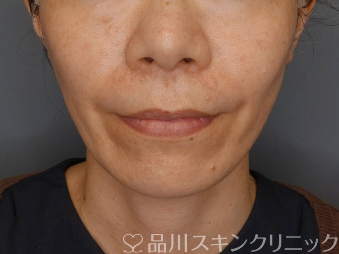 症例NO.71381のAFTER写真