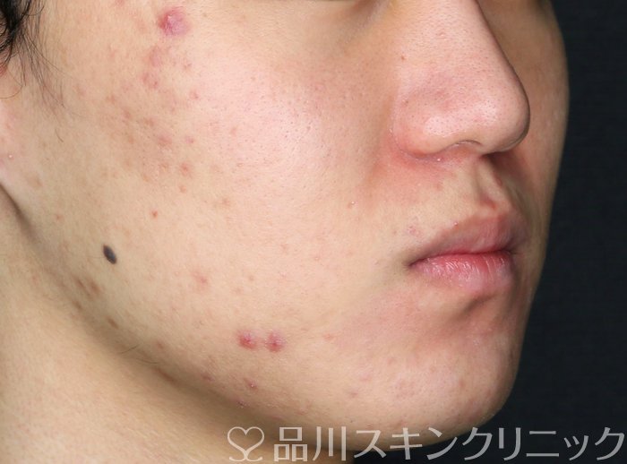 症例NO.74038のBEFORE写真