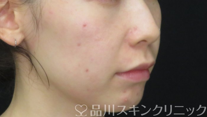 症例NO.71576のBEFORE写真