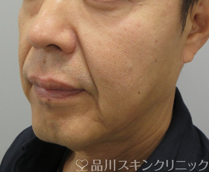 症例NO.74218のBEFORE写真