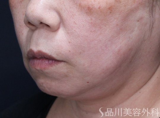 症例NO.74093のAFTER写真