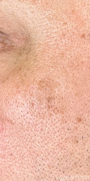 症例NO.71967のBEFORE写真