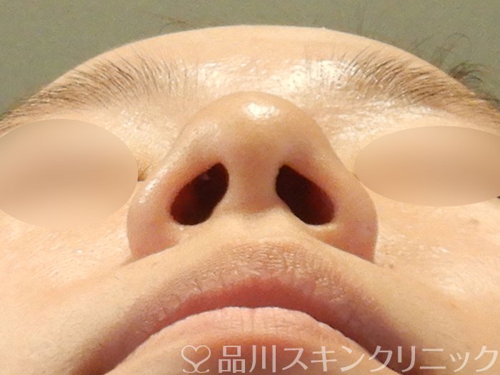 症例NO.70098のBEFORE写真