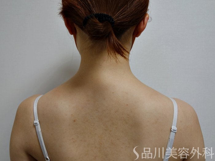 症例NO.73667のBEFORE写真