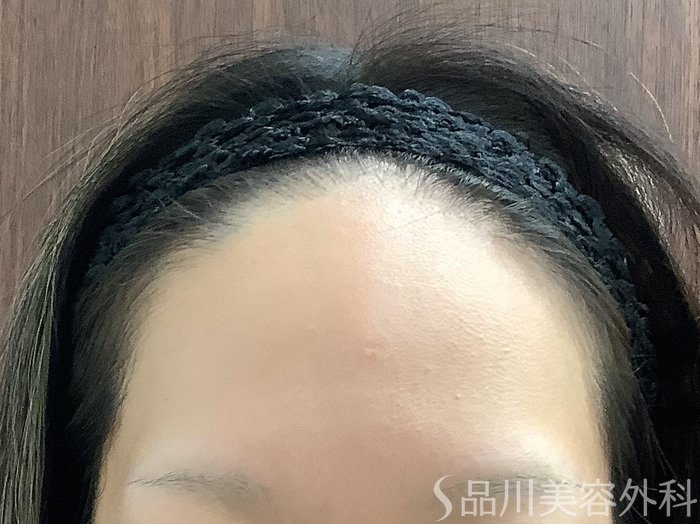 症例NO.67836のBEFORE写真