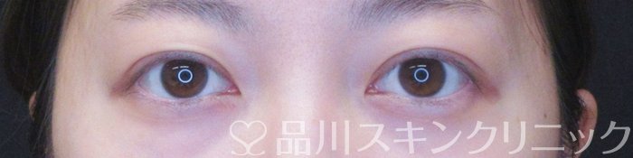症例NO.64896のAFTER写真