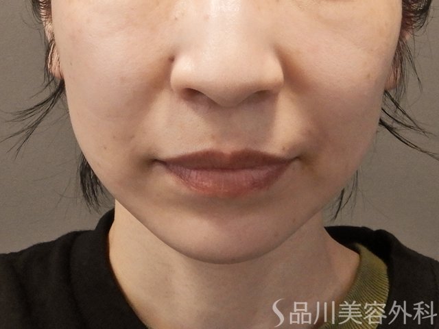 症例NO.74340のBEFORE写真