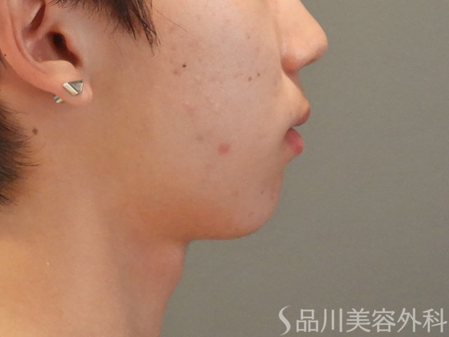 症例NO.74901のBEFORE写真