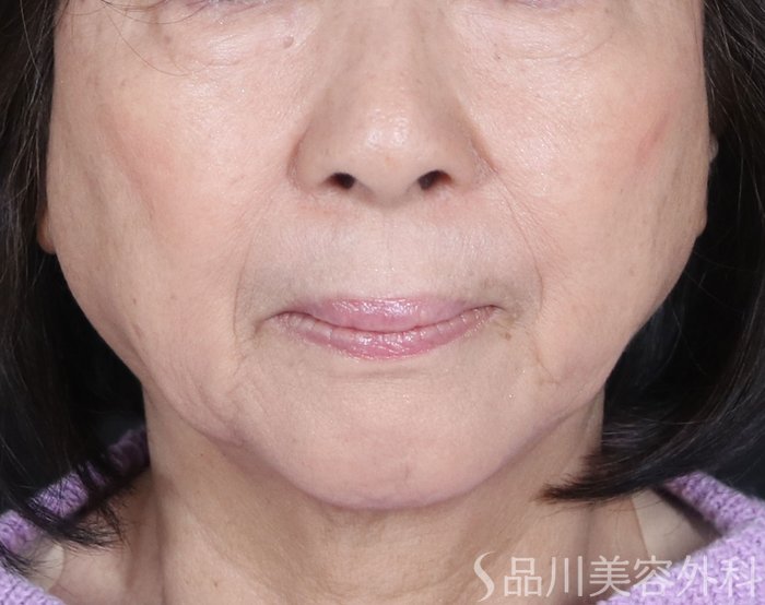 症例NO.73216のAFTER写真