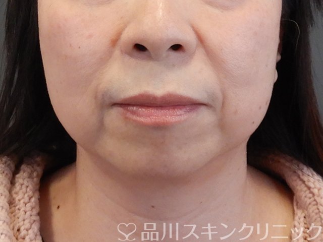 症例NO.69230のBEFORE写真
