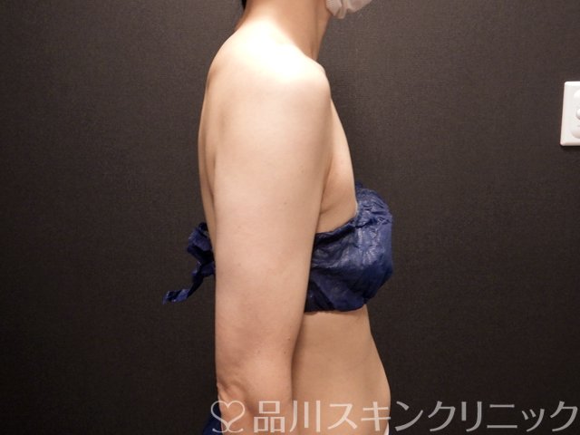 症例NO.66626のAFTER写真