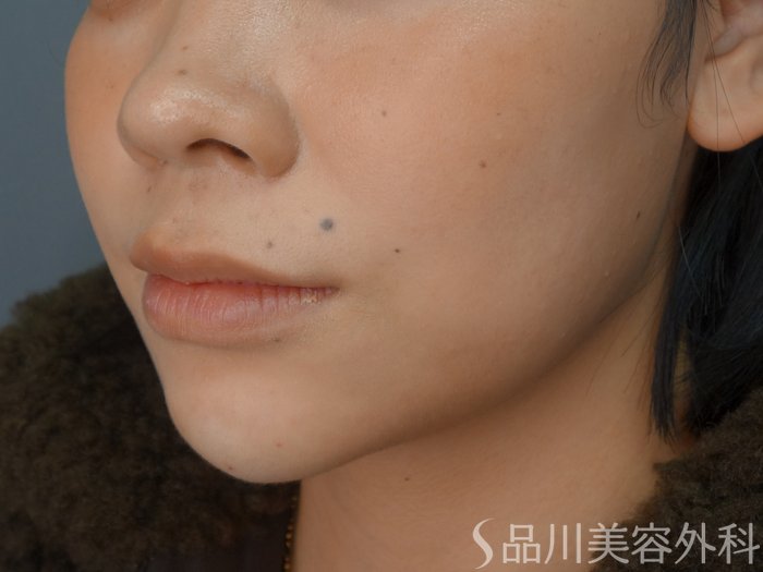 症例NO.73031のAFTER写真