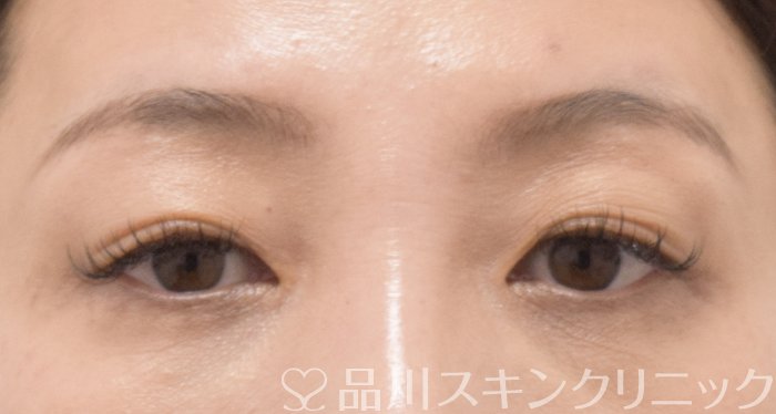 症例NO.70234のAFTER写真