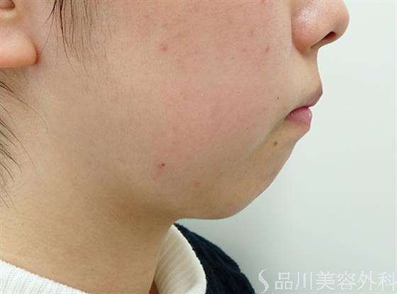 症例NO.47728のBEFORE写真