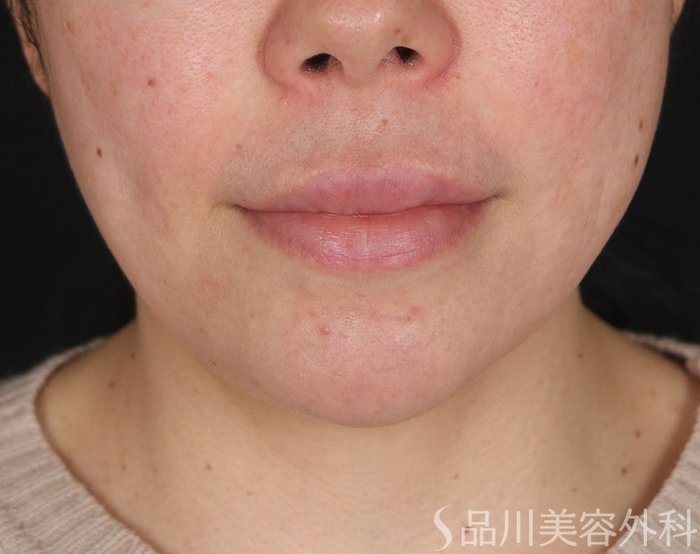 症例NO.73346のBEFORE写真