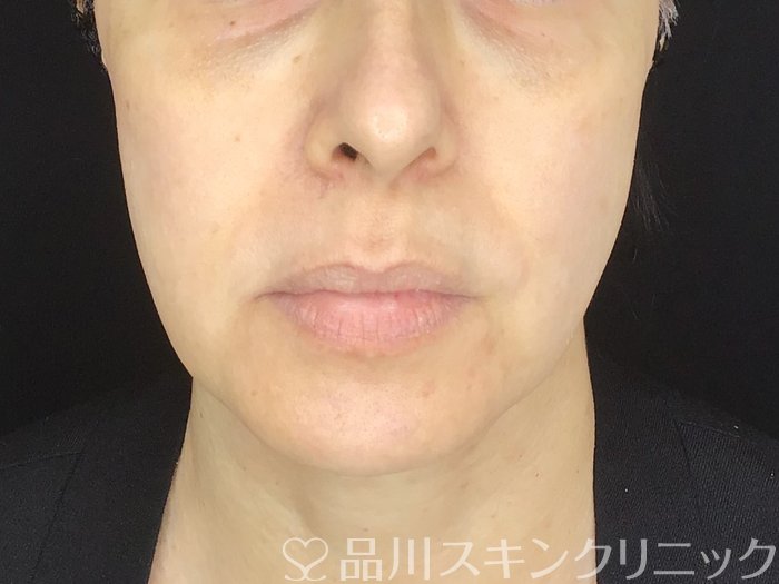症例NO.67696のBEFORE写真