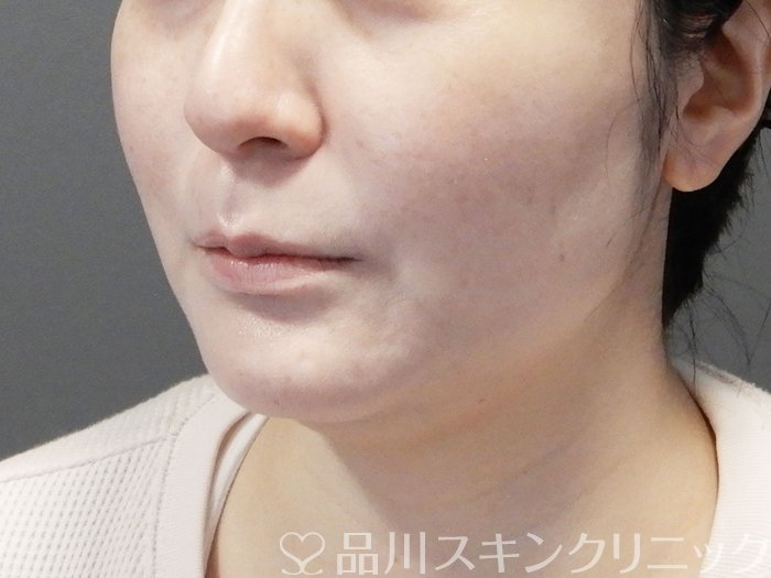 症例NO.73440のAFTER写真