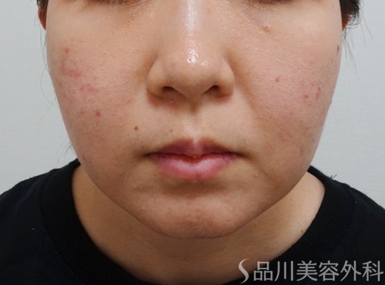 症例NO.73360のBEFORE写真