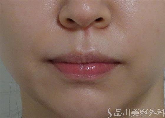 症例NO.53227のAFTER写真